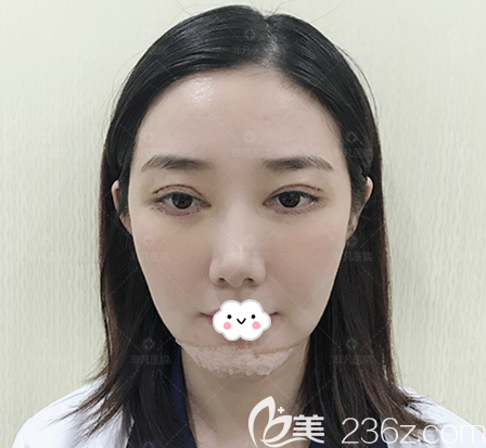 深圳非凡王天成雙眼皮修復術后3天