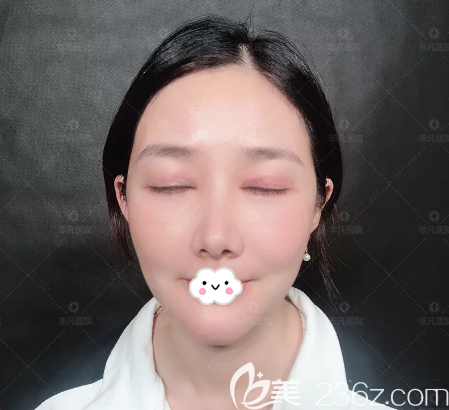 王天成院長雙眼皮修復7天拆線效果