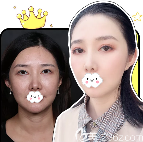 深圳非凡王天成做的雙眼皮修復案例對比圖