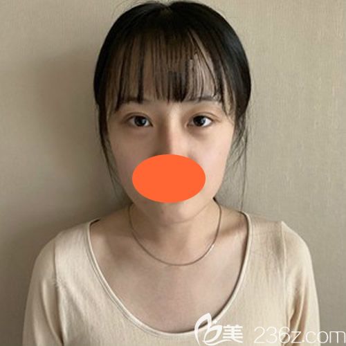 一個(gè)月前到西寧時(shí)光做脂肪填充全臉術(shù)前照片 一個(gè)月前到西寧時(shí)光做脂肪填充全臉術(shù)前照片