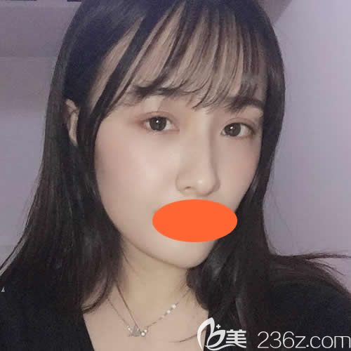 在西寧時(shí)光做全臉?lè)咎畛湫g(shù)后第5天 在西寧時(shí)光做全臉?lè)咎畛湫g(shù)后第5天