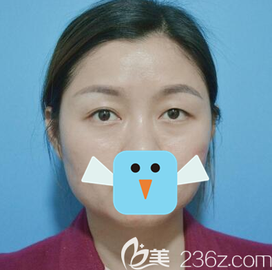 雙眼皮手術失敗術后大小眼 雙眼皮手術失敗術后大小眼