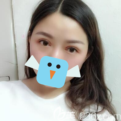 在四川達(dá)州雙均李隆才做那做雙眼皮修復(fù)手術(shù)2個月了，來說說我的手經(jīng)歷和術(shù)后感想