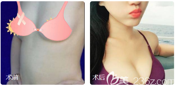 廣州星團(tuán)醫(yī)美趙輝隆胸案例前后對(duì)比圖 廣州星團(tuán)醫(yī)美趙輝隆胸案例前后對(duì)比圖