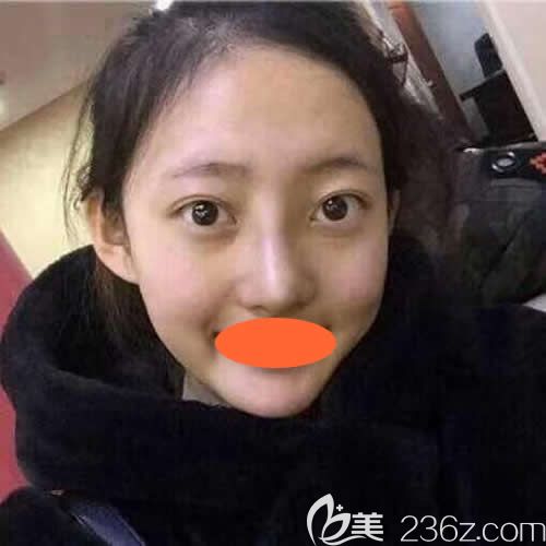 到西寧康華做自體脂肪填充全臉術(shù)后第15天