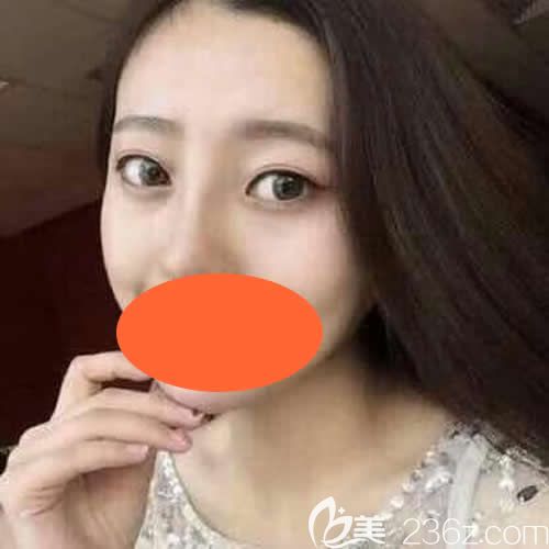 到西寧康華做自體脂肪填充全臉術(shù)后第28天