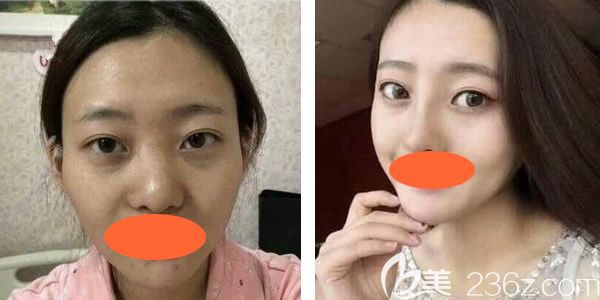 到西寧康華做自體脂肪填充全臉40天了，現(xiàn)在感覺填充過的地方飽滿緊致