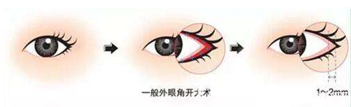 開(kāi)外眼角手術(shù) 開(kāi)外眼角手術(shù)