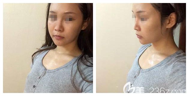 面診蘇州紫馨術(shù)前面頰凹陷 面診蘇州紫馨術(shù)前面頰凹陷