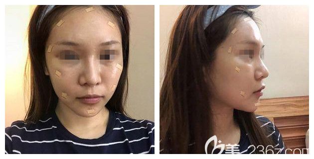 剛做完自體脂肪細胞膠填充面部術(shù)后即刻 剛做完自體脂肪細胞膠填充面部術(shù)后即刻