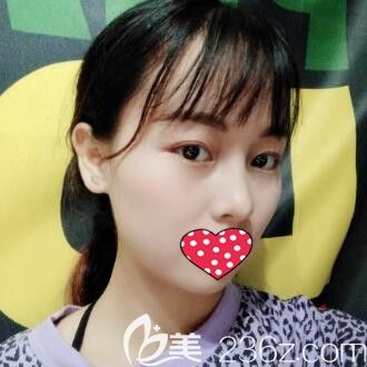 在希美做鼻綜合術(shù)后30天效果圖 在希美做鼻綜合術(shù)后30天效果圖