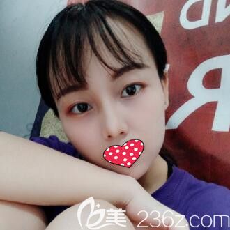 說下我找長沙希美蔣松林做達拉斯鼻綜合的親身經(jīng)歷及術(shù)后恢復(fù)效果圖片！