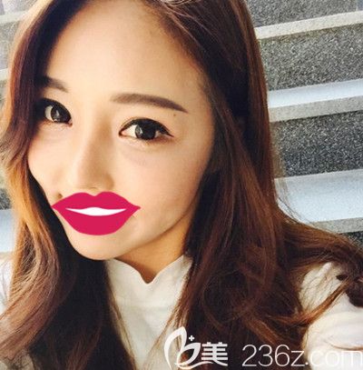 韓國自然主義眼睛+鼻子整形+全臉脂肪填充術(shù)后1個月