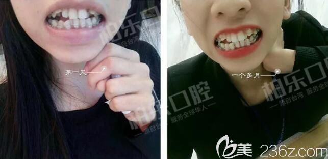 我在南寧柏樂口腔剛開始做牙齒矯正 我在南寧柏樂口腔剛開始做牙齒矯正