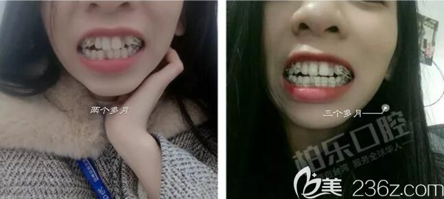 我在南寧柏樂口腔做半隱形牙齒矯正3個月效果 我在南寧柏樂口腔做半隱形牙齒矯正3個月效果