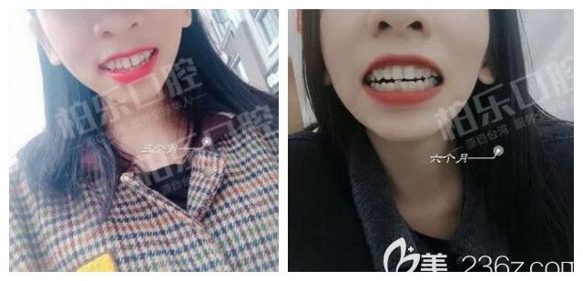 我在南寧柏樂口腔做半隱形陶瓷托槽牙齒矯正6個月 我在南寧柏樂口腔做半隱形陶瓷托槽牙齒矯正6個月