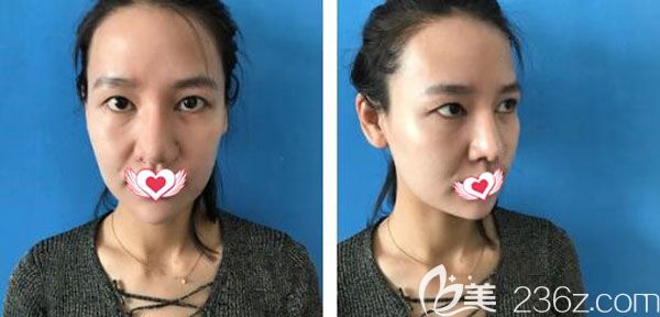 在<!--<i data=20240703-sp></i>-->割雙眼皮手術(shù)前 在<!--<i data=20240703-sp></i>-->割雙眼皮手術(shù)前