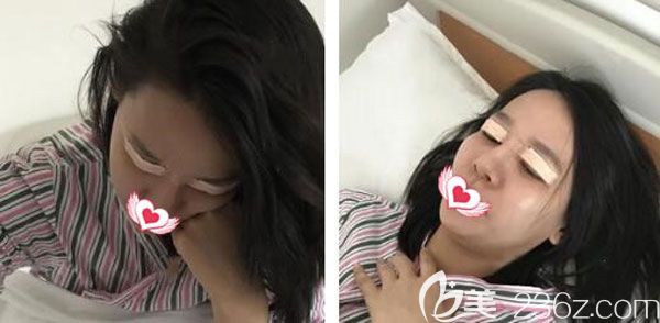 切開雙眼皮術(shù)后沒有滲血 切開雙眼皮術(shù)后沒有滲血