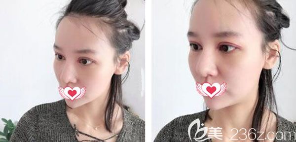 割雙眼皮術(shù)后第7天拆線線條流暢 割雙眼皮術(shù)后第7天拆線線條流暢