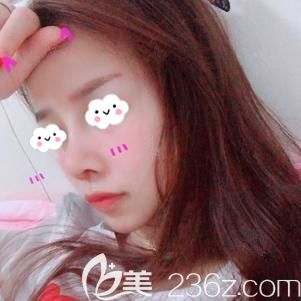 做鼻部修復(fù)術(shù)后7天拆線鼻小柱腫脹未消