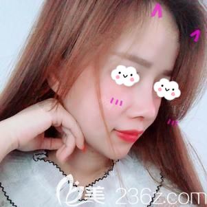 仇醫(yī)生做鼻部修復(fù)術(shù)后30天疤痕未消