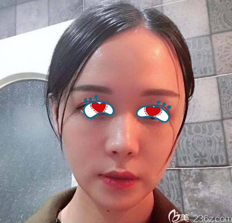 <!--<i data=20240703-sp></i>-->做面部自體脂肪填充術(shù)后第7天