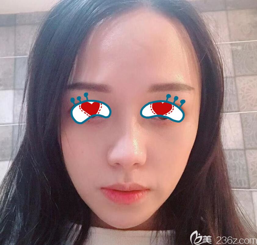 合肥壹美尚整形自體脂肪面部填充術(shù)后15天恢復(fù)情況