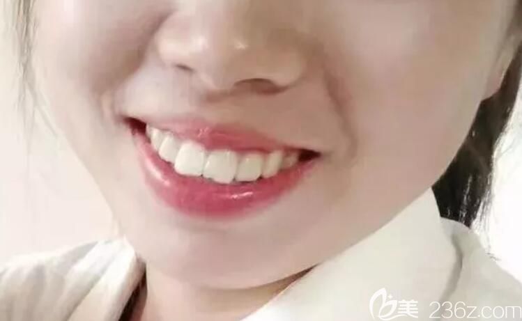 去<!--<i data=20240703-sp></i>-->永華口腔做齙牙矯正前正面臉型圖 去<!--<i data=20240703-sp></i>-->永華口腔做齙牙矯正前正面臉型圖