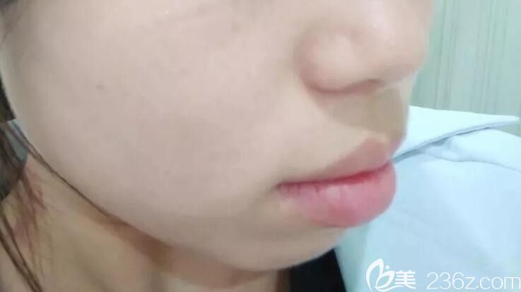 嘴凸齙牙矯正前側(cè)面圖 嘴凸齙牙矯正前側(cè)面圖