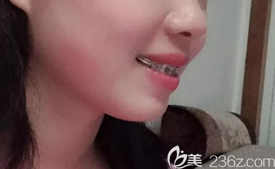 永華口腔戴鋼牙套9個月側(cè)臉照片 永華口腔戴鋼牙套9個月側(cè)臉照片