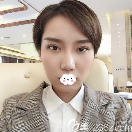 廣州海峽閆愛躍自體脂肪填充術(shù)后7天效果 廣州海峽閆愛躍自體脂肪填充術(shù)后7天效果