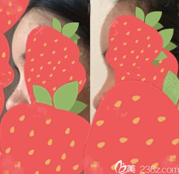 韓國ACE脂肪修復Lipolis針到底怎么樣 韓國ACE脂肪修復Lipolis針到底怎么樣