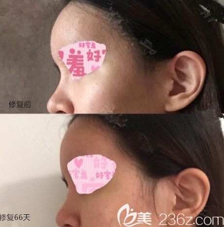 脂肪填充太多失敗韓國(guó)ACE金成雨脂肪修復(fù)Lipolis溶脂針解救了我6針價(jià)格24000