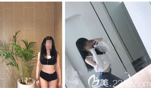 確認(rèn)過腰腹吸脂不會(huì)影響懷孕后到揚(yáng)州美貝爾做了吸脂術(shù)后可以穿露臍裝 分享自己的術(shù)后護(hù)理經(jīng)驗(yàn)