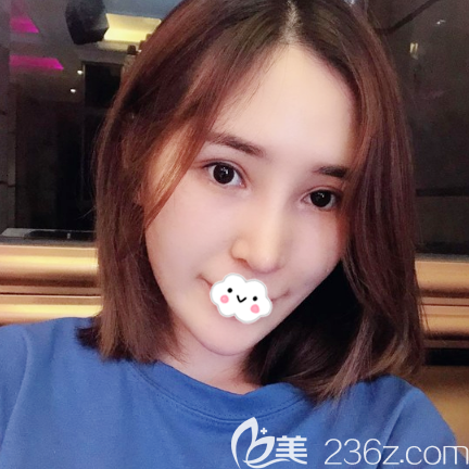 廣州紫馨李石峰隆鼻術(shù)后15天自拍 廣州紫馨李石峰隆鼻術(shù)后15天自拍