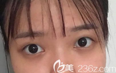 2個月前單眼皮的照片 2個月前單眼皮的照片