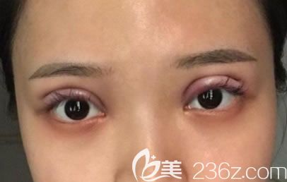 杭州薇琳剛做完雙眼皮的圖片 杭州薇琳剛做完雙眼皮的圖片