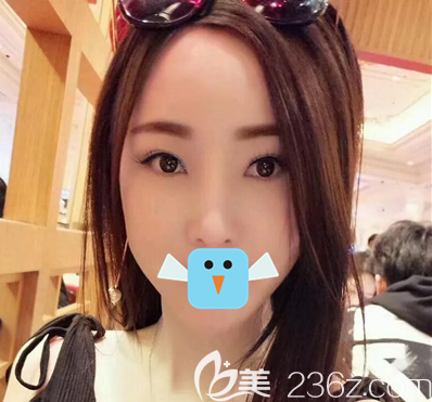 在達(dá)州雙均做了內(nèi)切去眼袋手術(shù)以后，眼袋淚溝黑眼圈都離我而去看起來不但精神還顯年輕