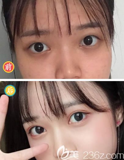 杭州薇琳醫(yī)美雙眼皮<span style= 杭州薇琳醫(yī)美雙眼皮<span style=