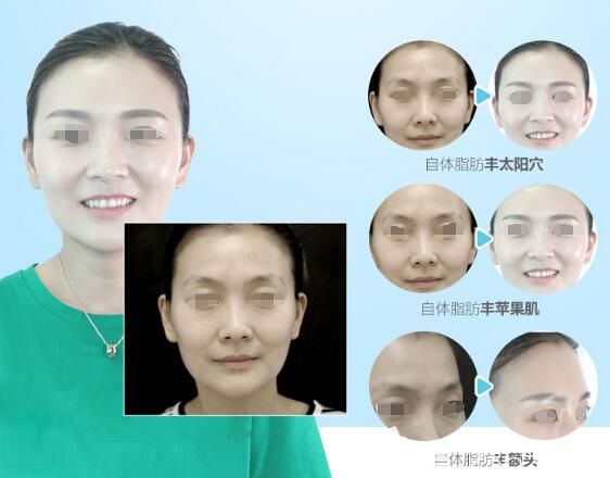 在徐州時光洪揚做自體脂肪面部填充案例