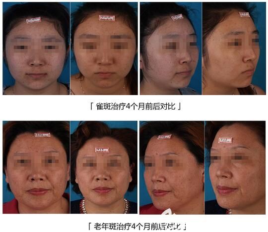 找曹洪揚醫(yī)生祛斑案例