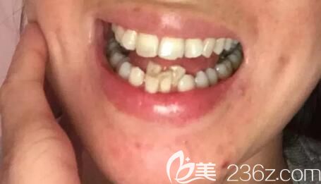 我在鄭州德正口腔做牙齒矯正前的照片 我在鄭州德正口腔做牙齒矯正前的照片