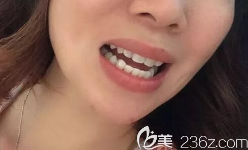 鄭州哪個口腔醫(yī)院做正畸好?分享我34歲在德正口腔做金屬托槽牙齒矯正的成功經(jīng)歷