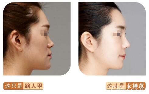 找曹洪揚醫(yī)生隆鼻案例