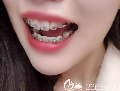 我在鄭州德正口腔做牙齒矯正第9個(gè)月 我在鄭州德正口腔做牙齒矯正第9個(gè)月