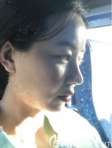 額頭脂肪填充太多在韓國(guó)ACE整形金成雨做了填充修復(fù)術(shù)效果簡(jiǎn)直無(wú)法反駁