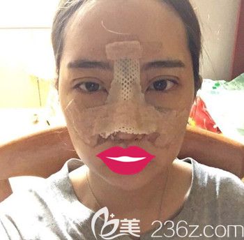 韓國朱諾做眼綜合+鼻綜合手術(shù)后3天 韓國朱諾做眼綜合+鼻綜合手術(shù)后3天