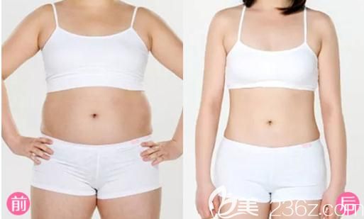 信陽易韓安和吸脂手術(shù)