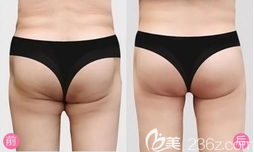 信陽易韓安和吸脂手術(shù)前后