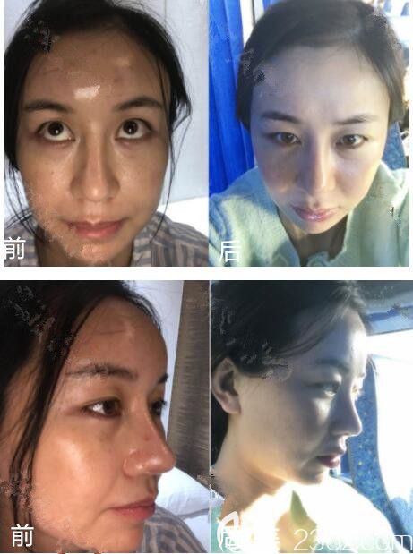 韓國ACE整形脂肪填充修復(fù)術(shù)真人案例 韓國ACE整形脂肪填充修復(fù)術(shù)真人案例